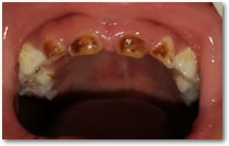 rollover image child with many cavities